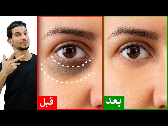 وصفه سحريه للتخلص من الهالات السوداء