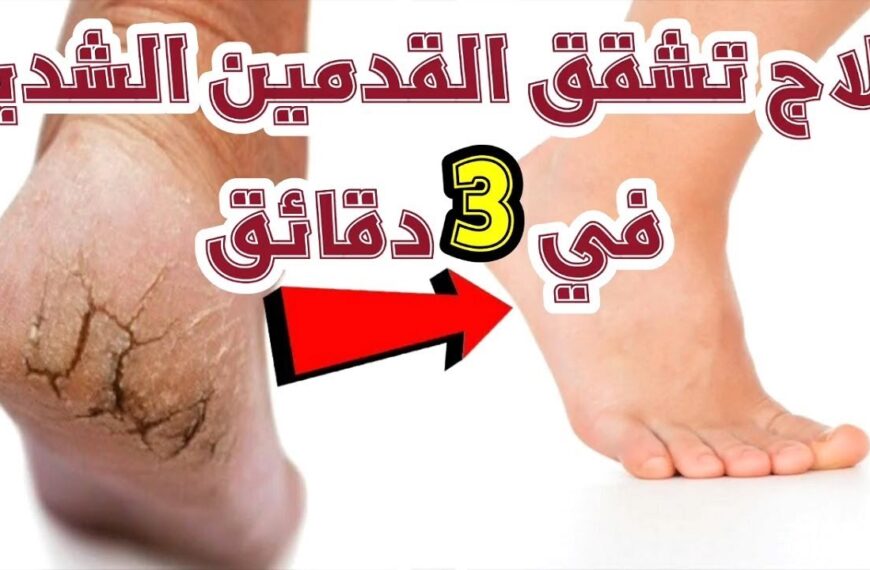 اقوي وصفة لتشققات القدمين بالملح والليمون