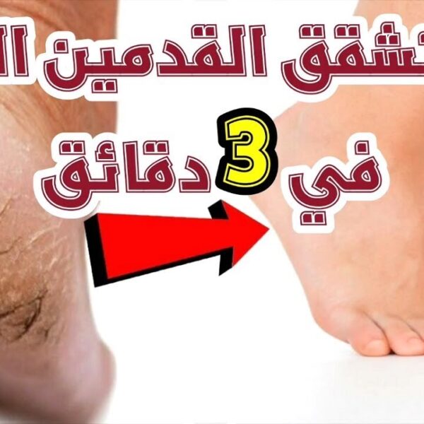 بدون ألم!! علاج تشققات القدمين