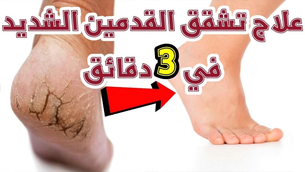 بدون ألم!! علاج تشققات القدمين