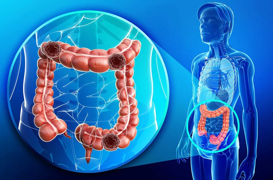سرطان الأمعاء